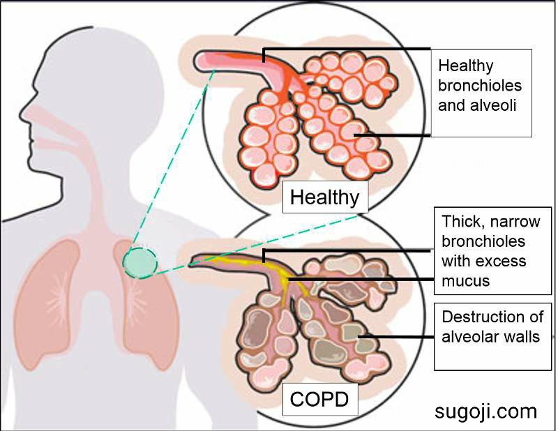 COPD(chronic obstructive pulmonary disease